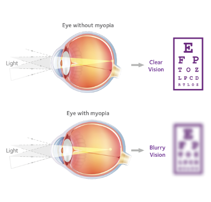 Comparison of an eye without myopia to an eye with myopia